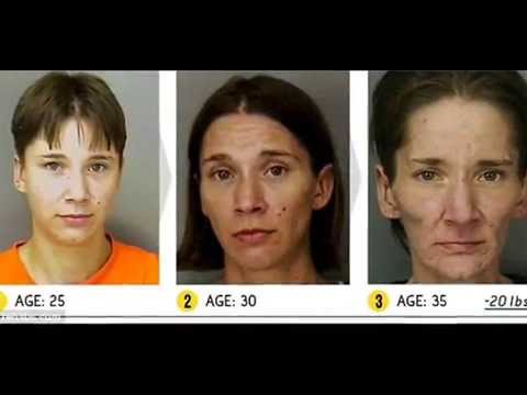 Disturbing Before And After Pictures Of Drug Abuse - It's Gonna Save Your Life- Meth And Heroin