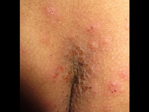Home Treatment Of Scabies